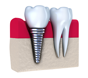 Dental Implants | Dentist In Flushing, MI | Flushing Dental Care